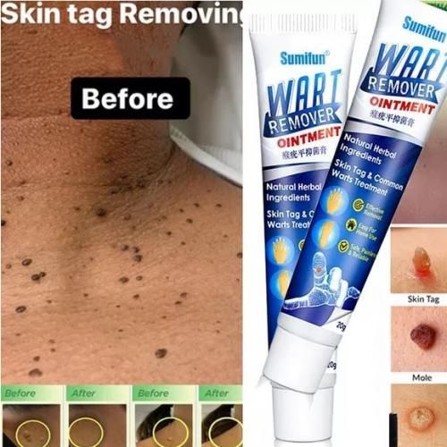 Herbal Warts Remover Ointment – Fast-Acting Mole & Wart Removal Cream for Face & Body