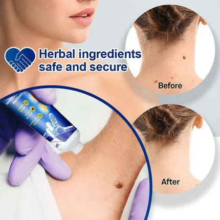 Herbal Warts Remover Ointment – Fast-Acting Mole & Wart Removal Cream for Face & Body