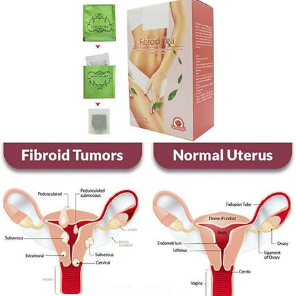 Fibroid Herbal Tea