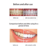 Glorysmile 5 Blue LED Teeth Whitening Kit 35% Carbamide Peroxide Gel 3 Syringes Home Dental Bleaching