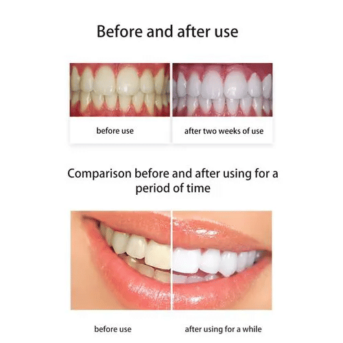 Glorysmile 5 Blue LED Teeth Whitening Kit 35% Carbamide Peroxide Gel 3 Syringes Home Dental Bleaching