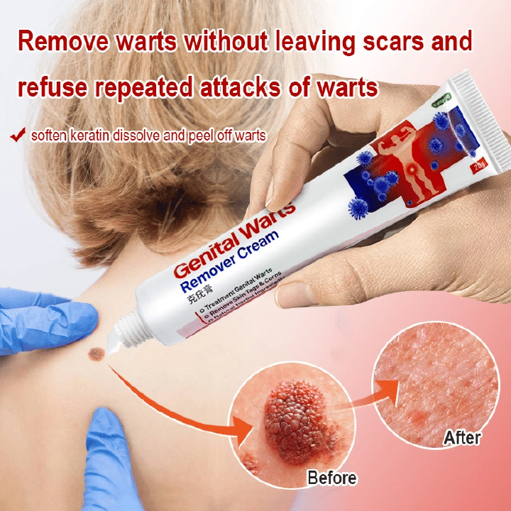 Genital Warts Remover Antibacterial Treatment Cream 20g