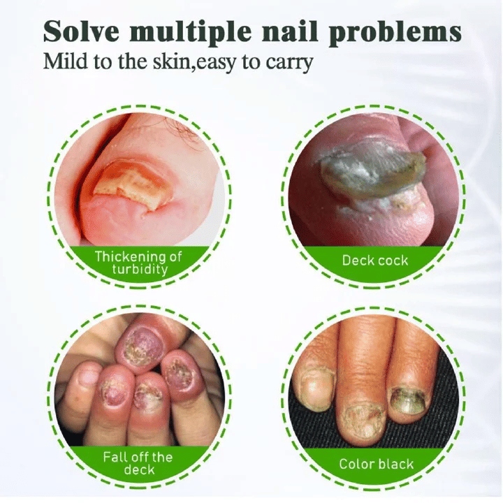 KanyeHB Nail Fungus Treatment Cream Onychomycosis Paronychia Removal Anti Infection Toe Foot Care Ointment 20g