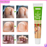 KanyeHB Nail Fungus Treatment Cream Onychomycosis Paronychia Removal Anti Infection Toe Foot Care Ointment 20g