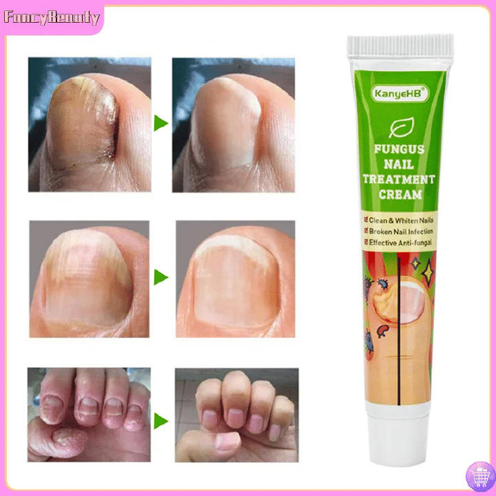 KanyeHB Nail Fungus Treatment Cream Onychomycosis Paronychia Removal Anti Infection Toe Foot Care Ointment 20g