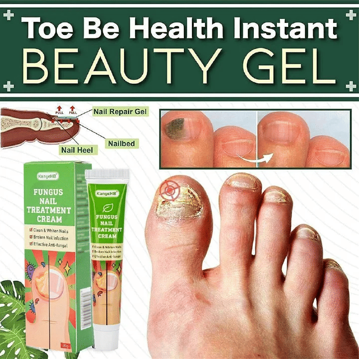 KanyeHB Nail Fungus Treatment Cream Onychomycosis Paronychia Removal Anti Infection Toe Foot Care Ointment 20g