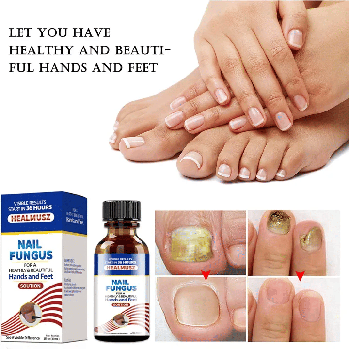Healmusz Nail Fungus Treatment Essence Removes Onychomycosis Nourishes Brightening Hands Feet Skincare