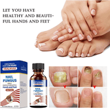 Healmusz Nail Fungus Treatment Essence Removes Onychomycosis Nails Nourishes Brightening Hands and Feet Skincare