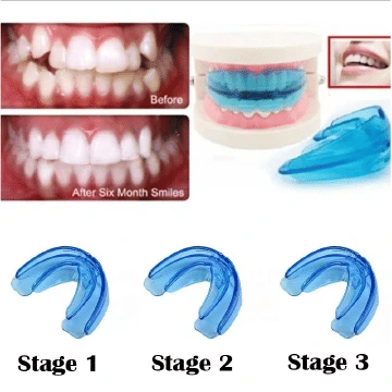Kilimall Teeth Alignment Braces Orthodontic Dental Straightener Trainer Mouthguard Tooth Tray